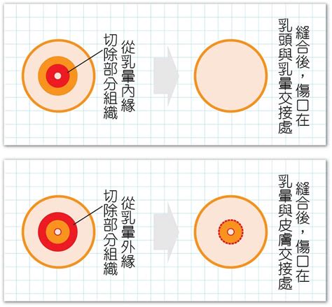 乳暈黑點|乳暈